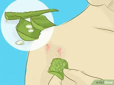 Image intitulée Stop Scratching Irritated Skin Step 13
