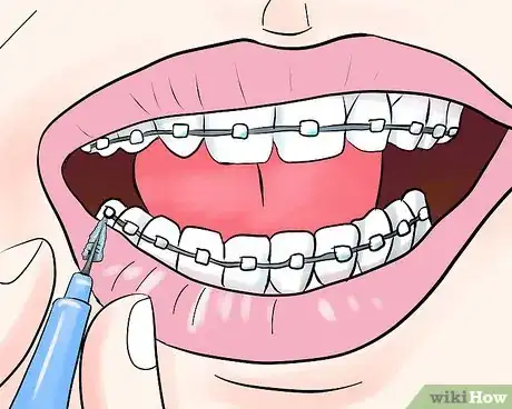 Image intitulée Take Care of Your Braces Step 4