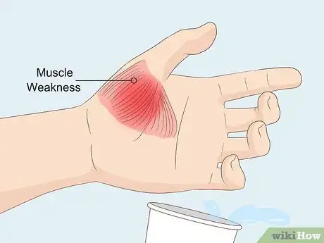 Image intitulée Know if You Have a Pinched Nerve Step 1