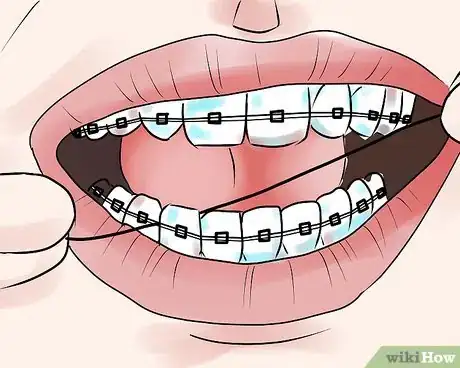 Image intitulée Take Care of Your Braces Step 3