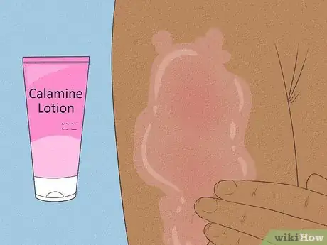Image intitulée Get Rid of Heat Rash Step 8