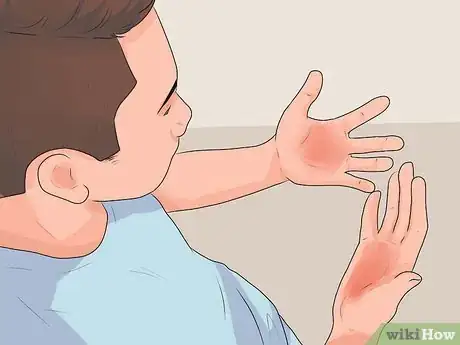 Image intitulée Treat a Hand Burn Step 17