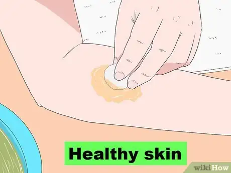 Image intitulée Treat Apple Cider Vinegar Burns Step 10