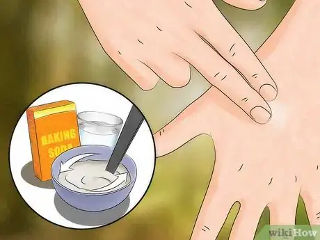 Image intitulée Get Rid of Bug Bites Step 5