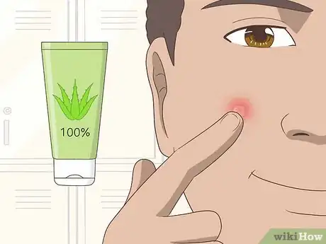Image intitulée Shrink Pimples Step 2