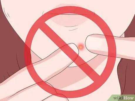 Image intitulée Get Rid of Keloids Step 15