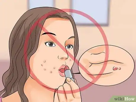 Image intitulée Deal With Pimples Step 8