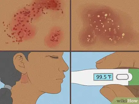 Image intitulée Get Rid of Heat Rash Step 11