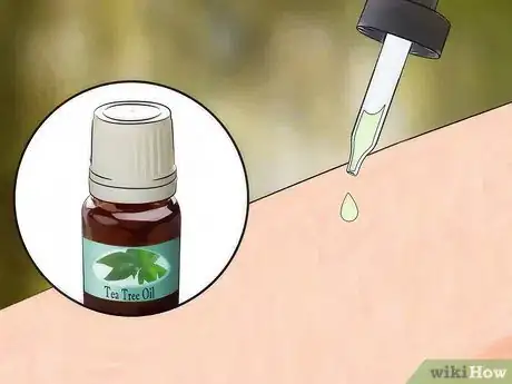 Image intitulée Get Rid of Bug Bites Step 11