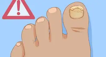 permettre à un ongle de pied de repousser rapidement