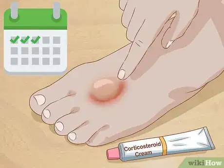 Image intitulée Get Rid of Poison Ivy Rashes Step 7
