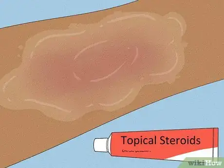 Image intitulée Get Rid of Heat Rash Step 10
