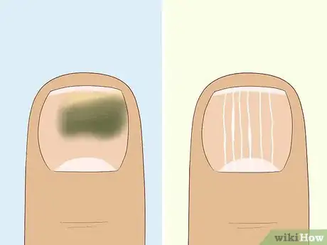 Image intitulée Heal Damaged Nails Step 1