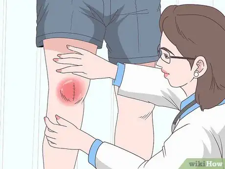 Image intitulée Reduce Swelling After Knee Surgery Step 6