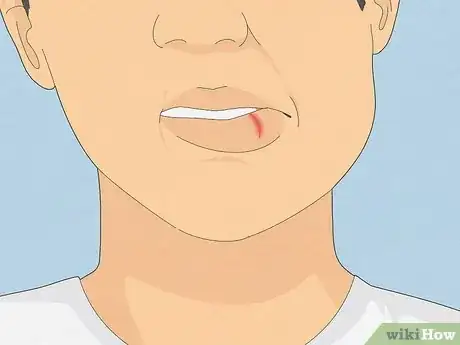 Image intitulée Treat a Cut Lip Step 4