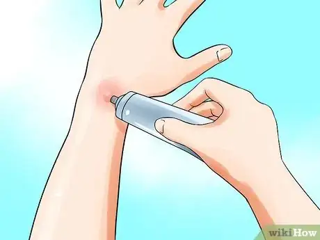 Image intitulée Treat No See Um Bites Step 11