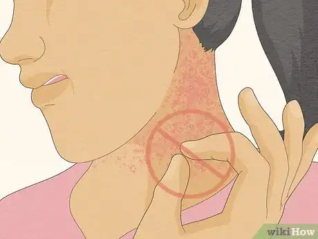 Image intitulée Treat Heat Rash Step 7