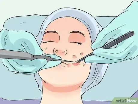 Image intitulée Decrease the Size of a Pimple Overnight Step 10
