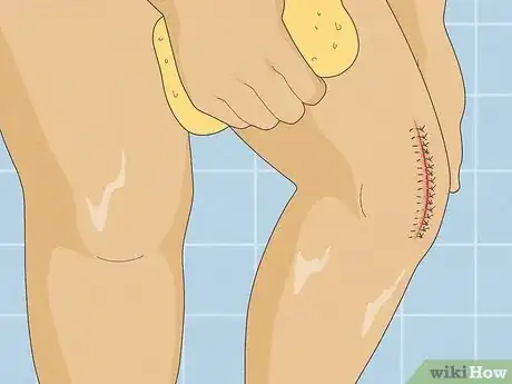 Image intitulée Take a Shower After Surgery Step 10