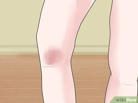 Image intitulée Tell if You Strained Your Knee Step 4
