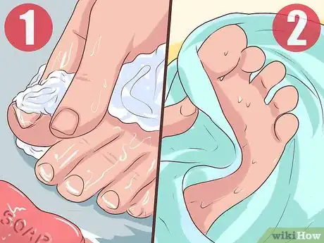 Image intitulée Treat a Torn Toenail Step 3