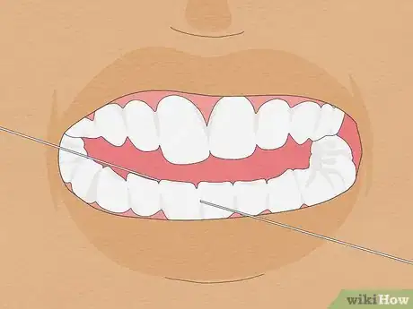 Image intitulée Fix Crooked Teeth Step 28