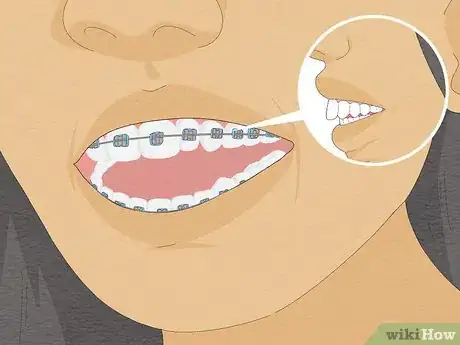 Image intitulée Fix Crooked Teeth Step 18