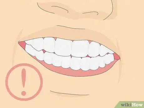 Image intitulée Fix Crooked Teeth Step 16