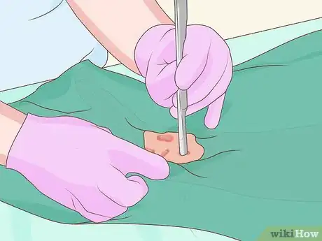 Image intitulée Get Rid of Keloids Step 6