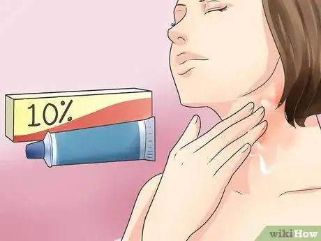 Image intitulée Recognize Scabies Rash Step 10