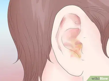 Image intitulée Know if You Have Labyrinthitis Step 5