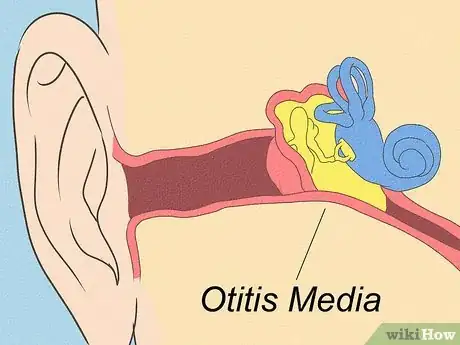 Image intitulée Differentiate Bacterial Tonsillitis and Viral Tonsillitis Step 9
