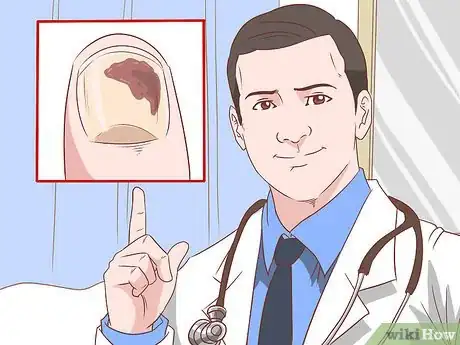 Image intitulée Deal With the Pain of a Door Being Shut on Your Finger Step 11