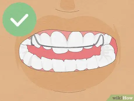 Image intitulée Fix Crooked Teeth Step 11