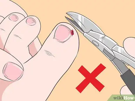 Image intitulée Fix Thick Toenails Step 4