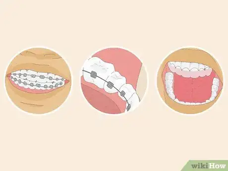 Image intitulée Fix Crooked Teeth Step 20