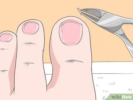 Image intitulée Fix Thick Toenails Step 3