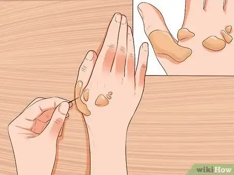 Image intitulée Treat a Facial Burn from a Curling Iron to Prevent Scars Step 12
