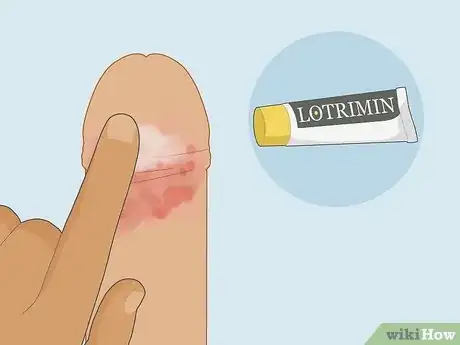 Image intitulée Cure Balanitis Step 10