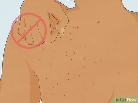 Image intitulée Treat Sand Flea Bites Step 6