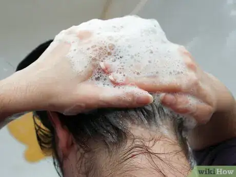 Image intitulée Treat Seborrheic Dermatitis Step 7