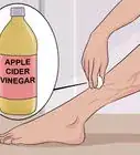 se débarrasser des varices