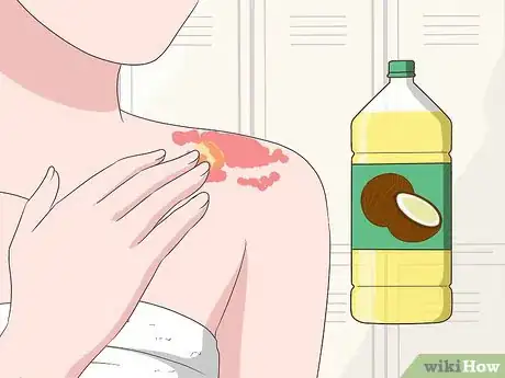 Image intitulée Treat Psoriasis Naturally Step 7