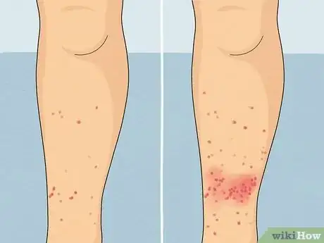 Image intitulée Treat Sand Flea Bites Step 8