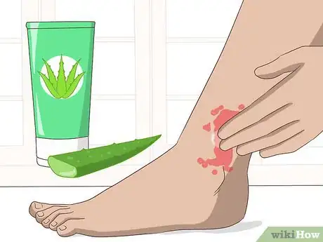 Image intitulée Treat Psoriasis Naturally Step 2