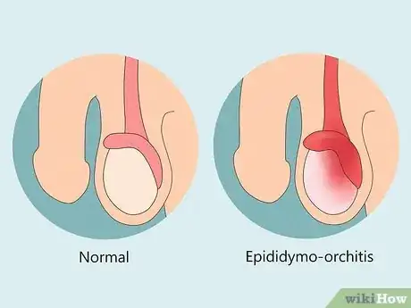 Image intitulée Treat Pain and Swelling in the Testicles Step 11