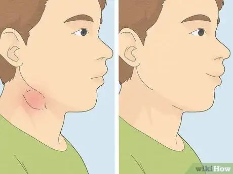 Image intitulée Reduce Lymph Node Swelling Step 11