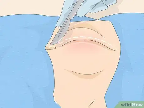 Image intitulée Treat Constipation After Hernia Surgery Step 18