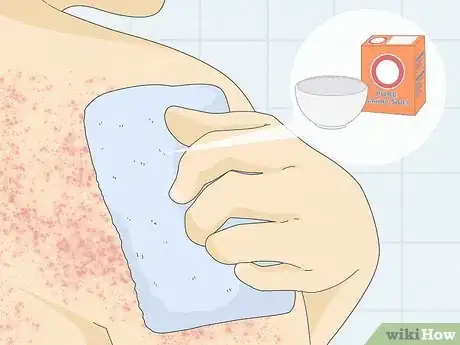 Image intitulée Treat Heat Rash Step 6
