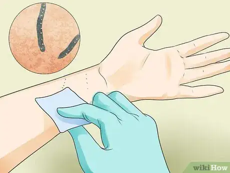 Image intitulée Recognize Scabies Rash Step 7